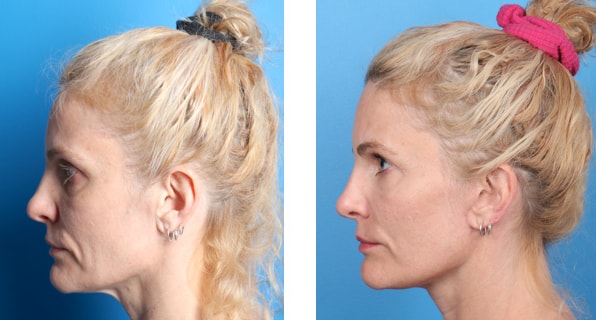 Benefits Of Facelift Surgery